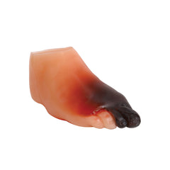 Diabetic  foot Model