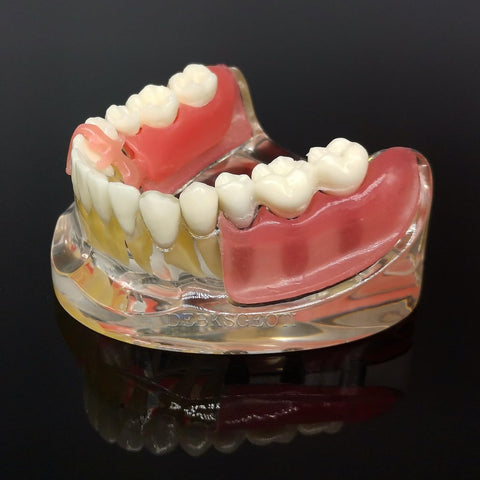 prosthetic implant dental model