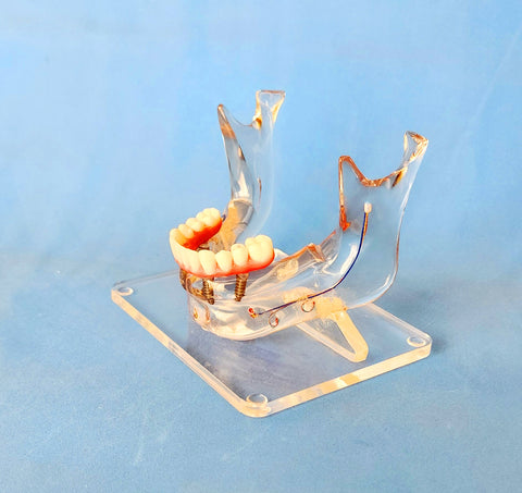 dental sinuses veneer bridge implant model 